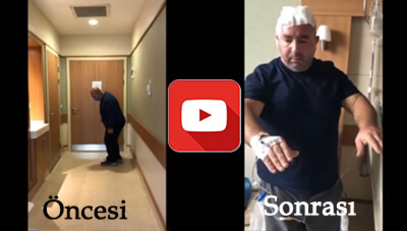 İLACA DİRENÇLİ PARKİNSON HASTAMIZIN BEYİN PİLİ AMELİYATI SONRASI DEĞİŞİMİ