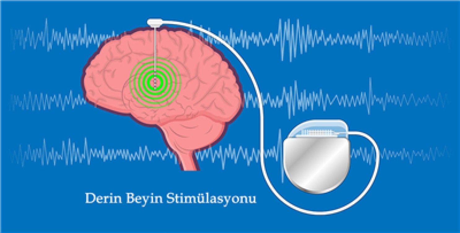 DERİN BEYİN STİMÜLASYONU TEKNOLOJİSİNDEKİ SON GELİŞMELER