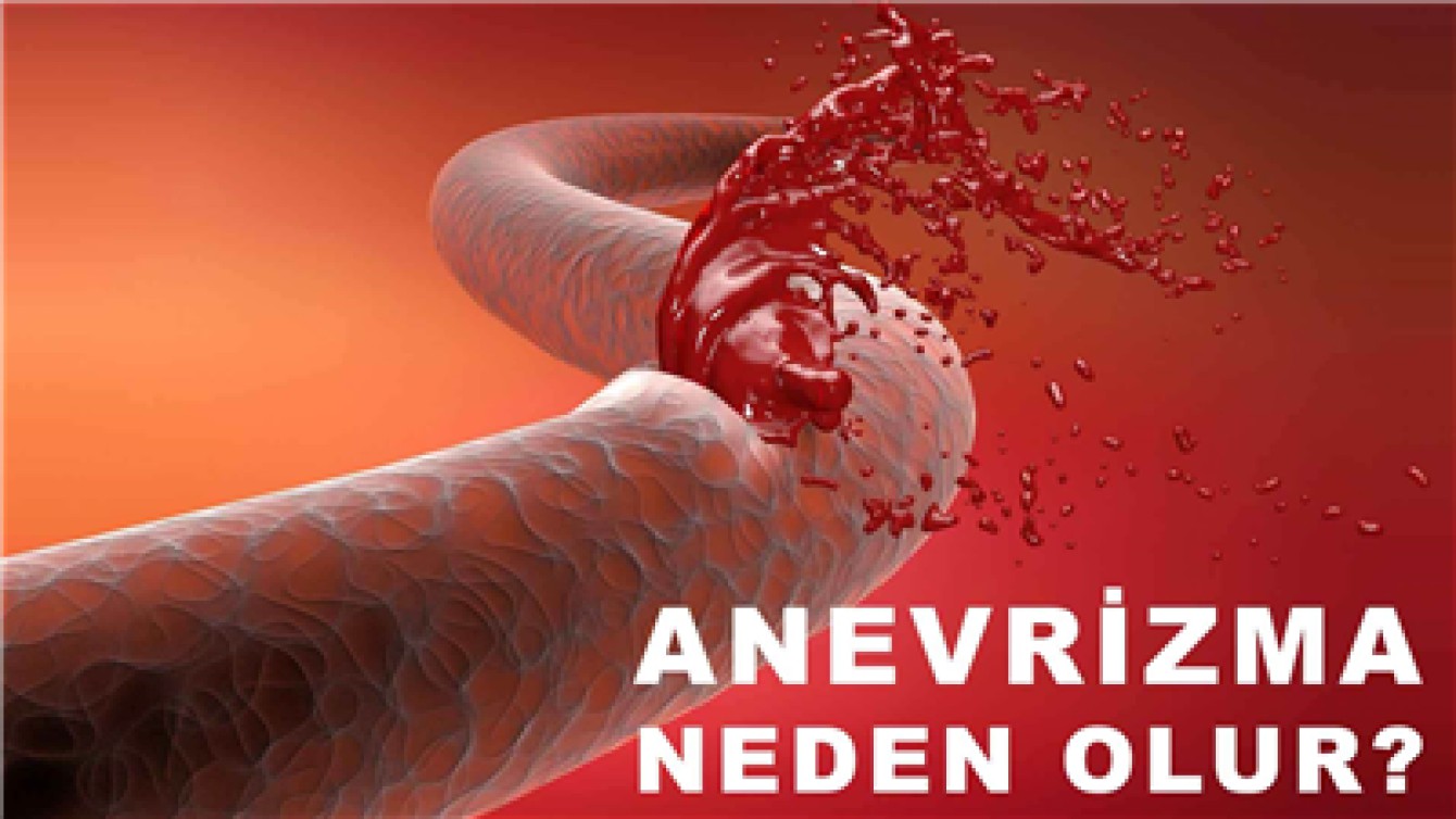 ANEVRİZMA NEDEN OLUR?