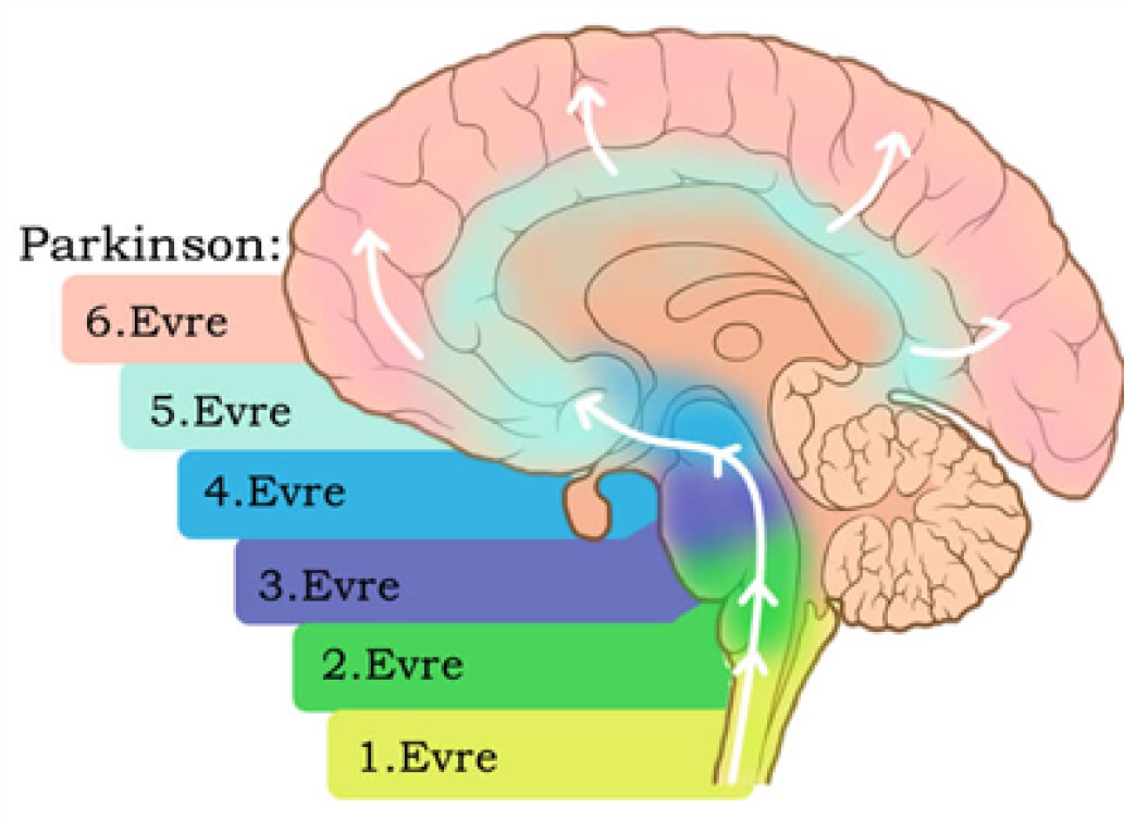 PARKİNSON HASTALIĞININ EVRELERİ VE BEYİN PİLİ TEDAVİSİ